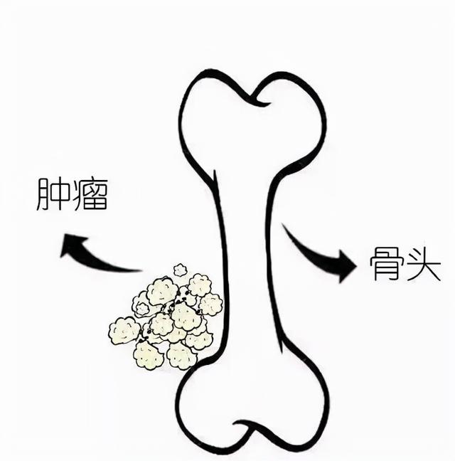 你以为孩子是“生长痛”，谁知竟会是骨肿瘤