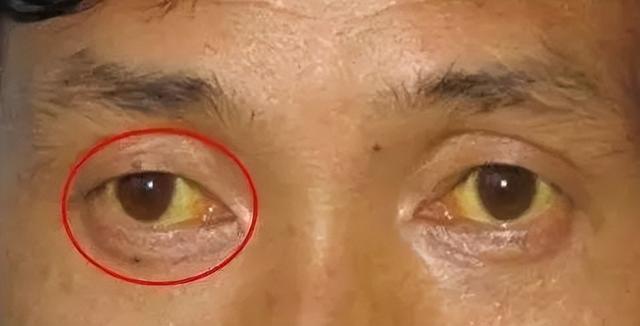 肝硬化的人或因面条吃多了？提醒：若想养肝，2种食物最好少吃