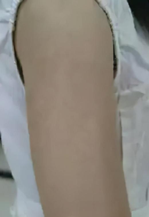 鱼鳞病手脚角化