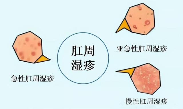 肛门角化型湿疹