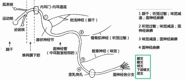 特发性面神经麻痹的诊疗