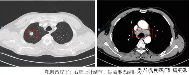患者故事 | 局部晚期肺癌的我術后三個月后暢游長江