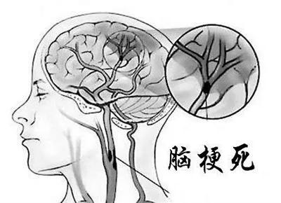 睡前可适量喝水！专家教你科学防治脑梗塞