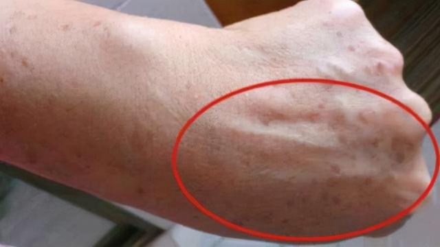 皮肤脂溢性角化症擦什么药膏