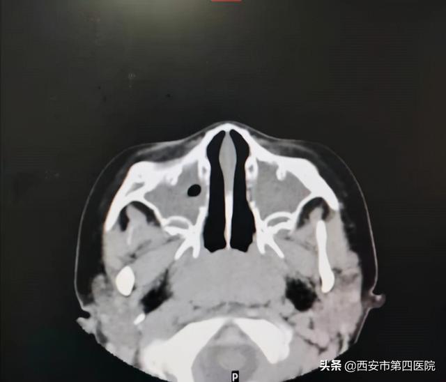 孩子反复咳嗽、鼻塞、流脓性鼻涕，以为是“感冒”？ 这都是鼻窦炎惹的祸！