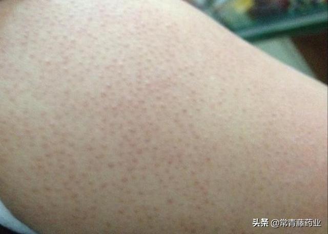 基因有鸡皮肤吗