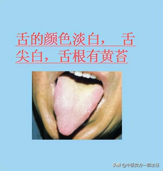临床常见的9种舌象，对照自测