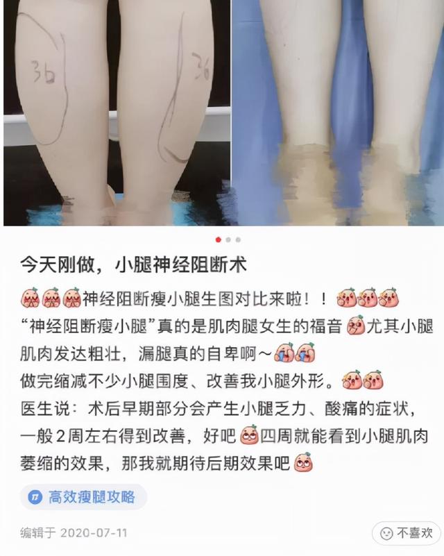 33岁女网红抽脂致死：醒醒吧，被容貌焦虑毁掉的女孩