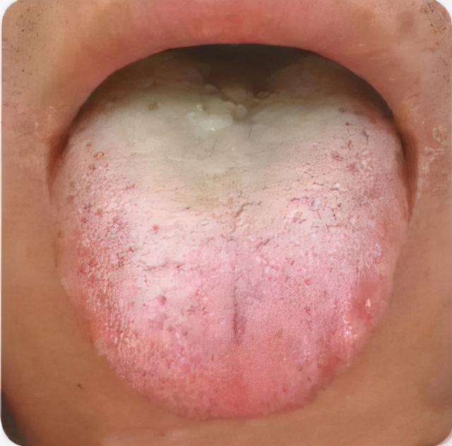 痰湿百病生！为什么说结节与“痰湿”有关，老中医讲述结节的本质