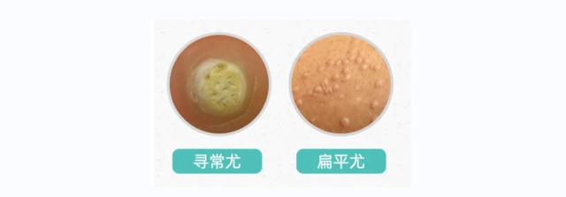 HPV有什么癥狀？怎樣發現HPV感染？