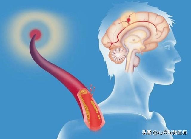 老年人预防脑梗，补充叶酸很重要，如何补才正确？总结3个要点