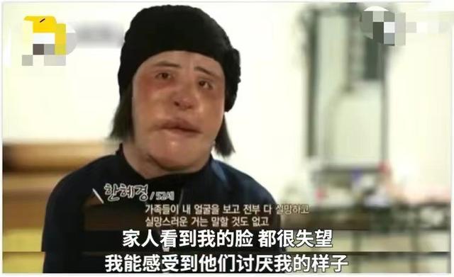韩慧景：把自己整成“电风扇”，注射食用油代价惨痛，我悔不当初