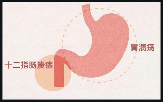 胃溃疡和十二指肠溃疡如何辨别？幽门螺杆菌是不是唯一病因？