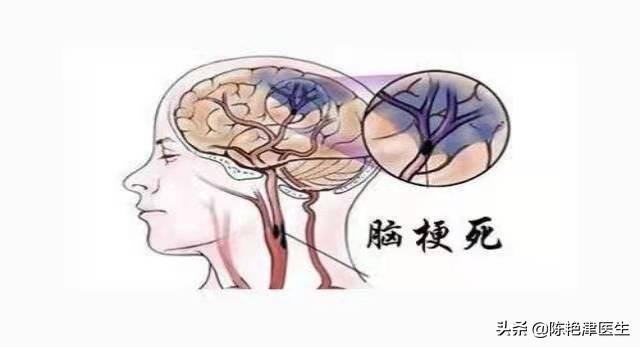 为什么中国脑梗越来越多？医生：除了补充叶酸，做好这3点更重要