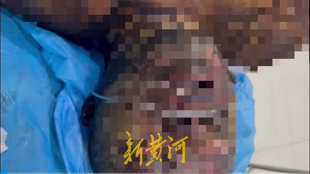 哈尔滨男子烧伤死亡施救者发声