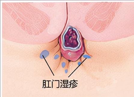 肛门角化型湿疹
