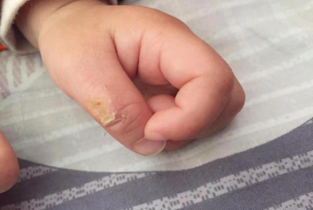 婴儿一直吃手会有什么影响「宝宝经常吃手指对手指有什么影响」