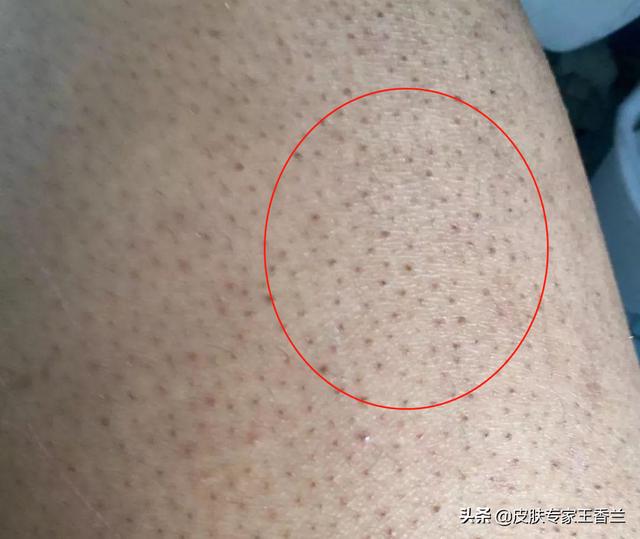 毛周角化可以使用脱毛仪吗
