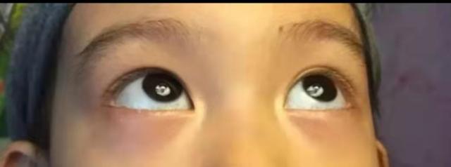 孩子为什么有眼袋,眼睑发红发青呢?