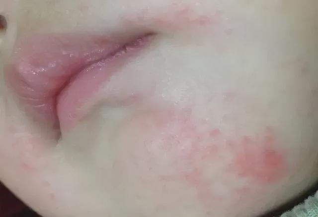 又一网红宝宝霜出事了！6大常见疹子，治疗千万别乱来
