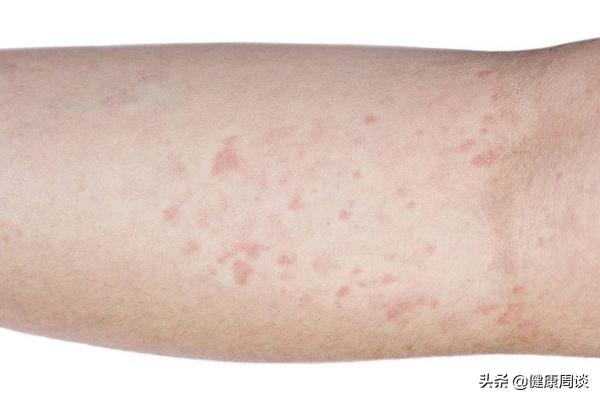 鸡皮肤后背图片