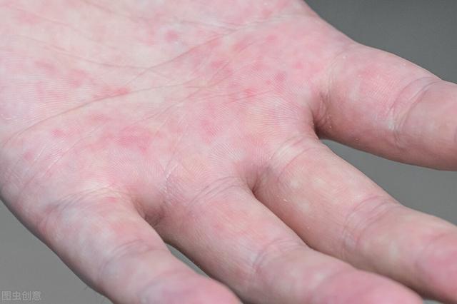 天气热手汗如雨下？或是患上这4种疾病，老中医给出3种调理方法