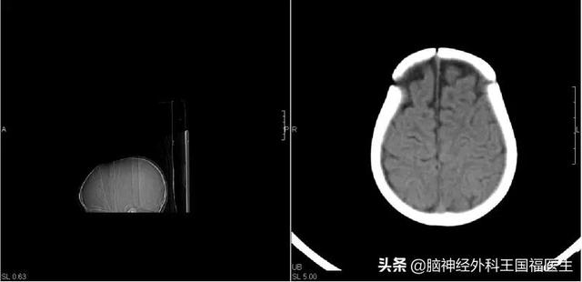 孩子忽然呆住持续1分钟，上课突然起身，是癫痫？!还有隐藏病因..