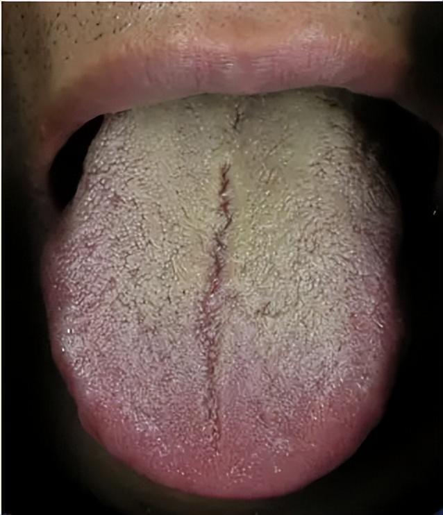 肺里有痰，咳嗽胸闷，胃里有痰，口臭恶心！一个中成药，刮净痰浊