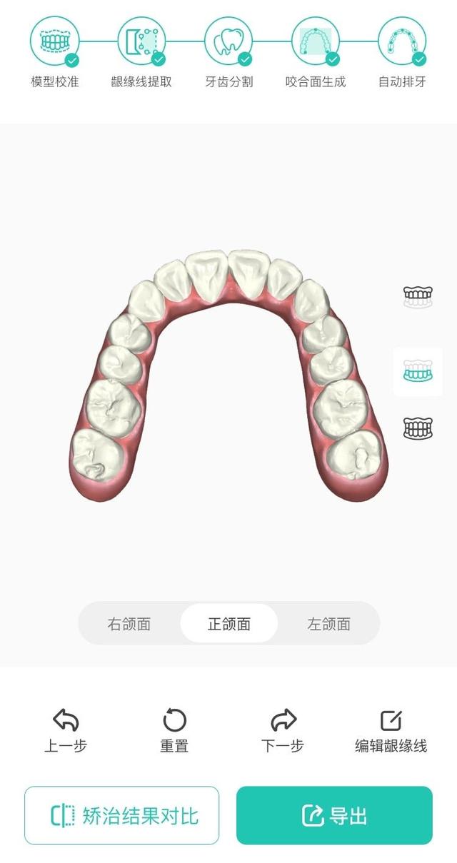 象贝AI正畸排牙系统Venus1.0发布 开辟数字化牙科新纪元