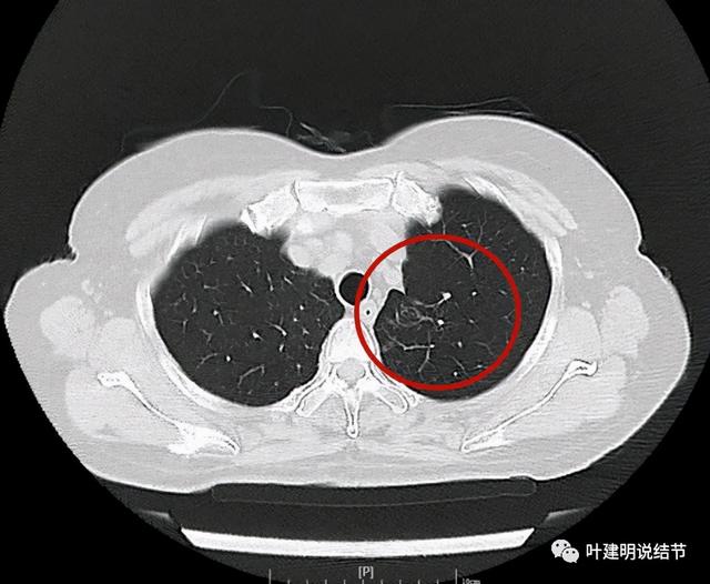 左肺占位进一步检查什么意思