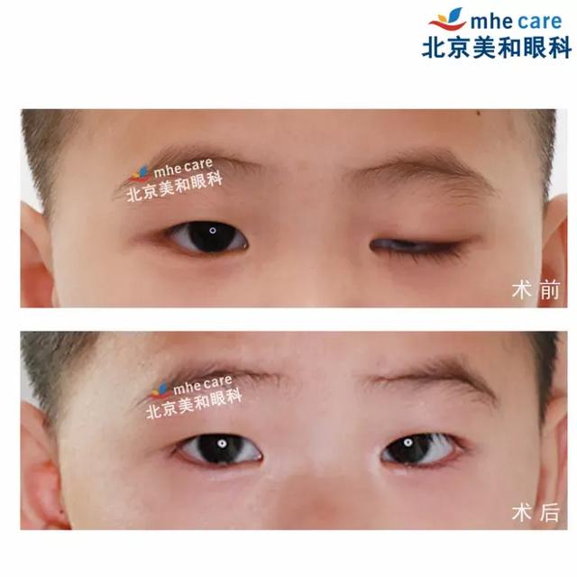 五年八部曲，上睑下垂分阶段治疗的故事