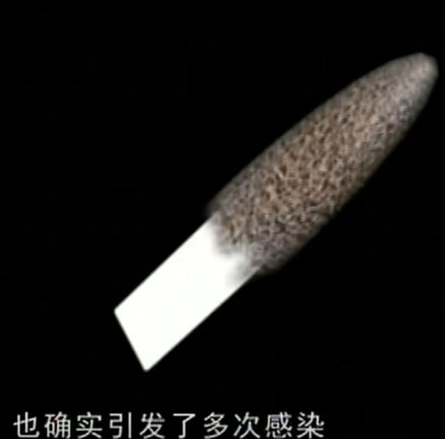 11年云南男子头疼呕吐，身上散发臭味，检查发现脑中插着一把匕首