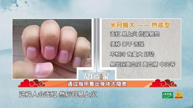 手指甲满足3个特点，多半是身体在“求救”！赶紧自测