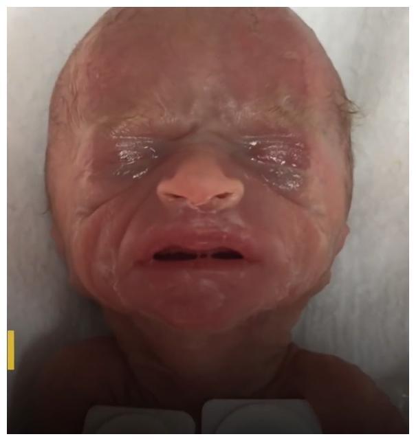 26周早产儿，出生不到1斤只有巴掌大，奇迹生还长成大美人