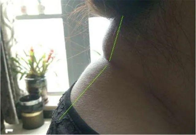 横纹是脑梗纹、竖纹是脑出血纹、凸起是炸药包，一定要及时疏通