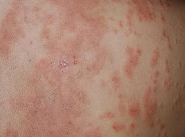 治疗掌趾角化症的药膏