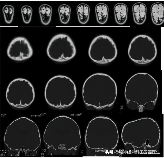 孩子忽然呆住持续1分钟，上课突然起身，是癫痫？!还有隐藏病因..