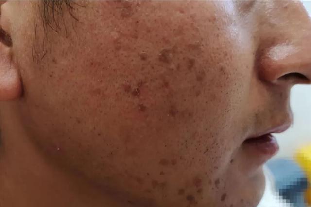 手心透明疙瘩点状角化病