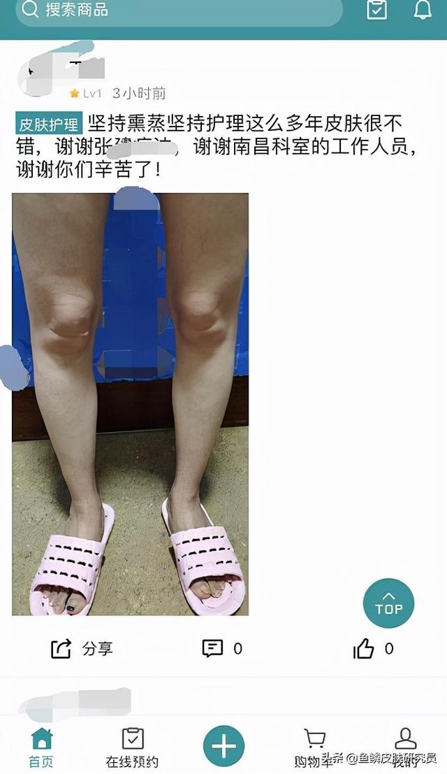 鱼鳞病有人治好的吗