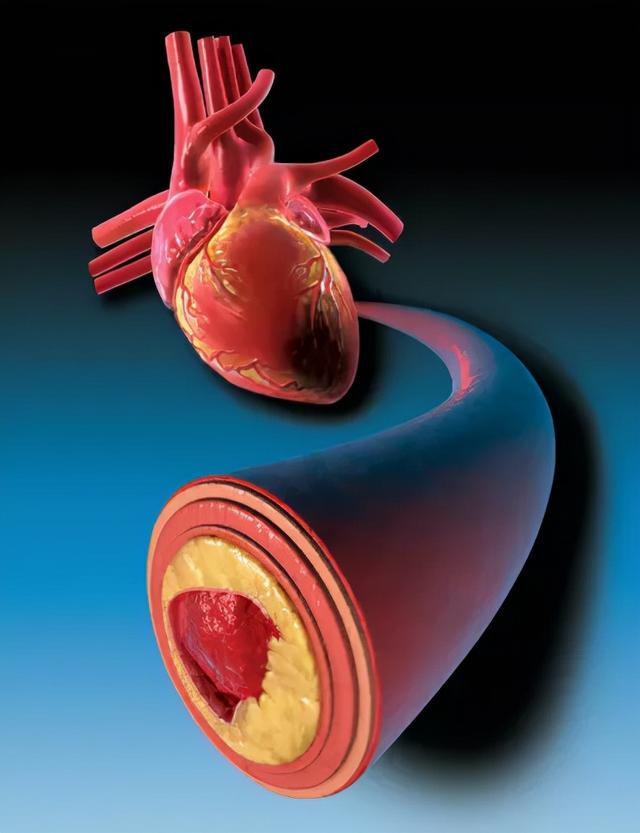 冠状动脉狭窄或斑块？看中医吃中药可以改善吗？