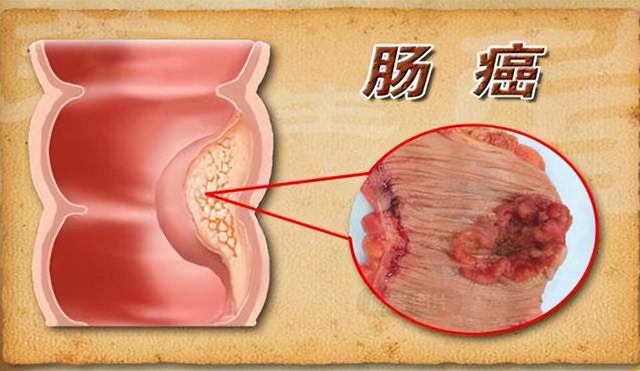 結直腸癌的下一代測序可檢測六分之一患者的生殖系易感性