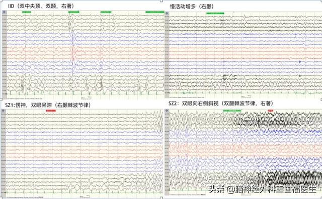 孩子忽然呆住持续1分钟，上课突然起身，是癫痫？!还有隐藏病因..