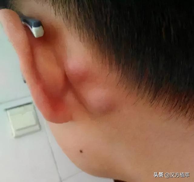 耳朵后面的硬包可能是因为淋巴发炎肿大而导致的,平时淋巴都是不能