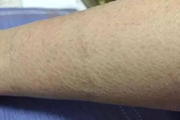 狗身上有鱼鳞状皮屑