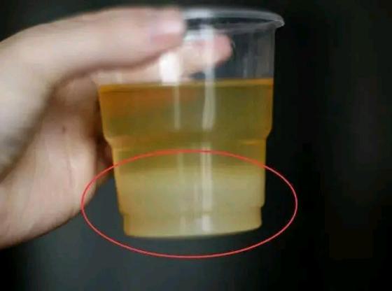 得了糖尿病要重视，牢记这8种就医信号，出现后及时就医
