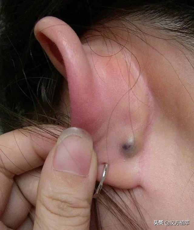腮腺淋巴瘤图片耳朵图片