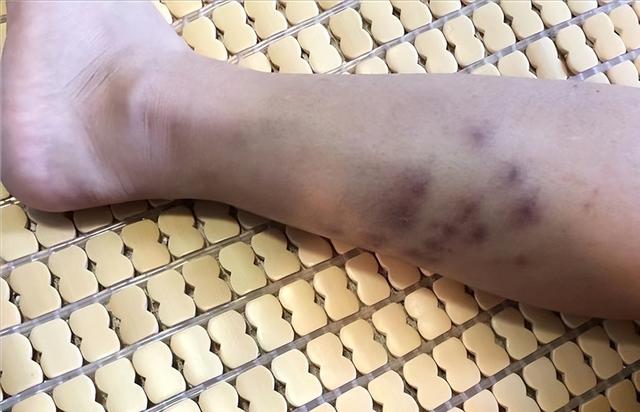 红火蚁再伤人！广西一女子被咬伤！伤势严重！被咬了该怎么办？