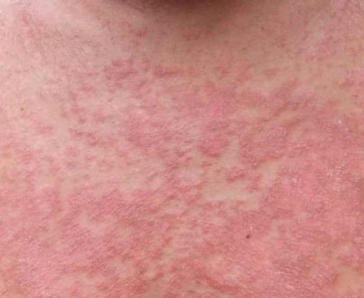 治疗掌趾角化症的药膏