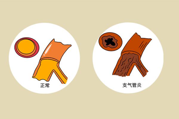 黄痰、白痰、黑痰、血性痰，分别提示什么健康问题？痰多咋办？