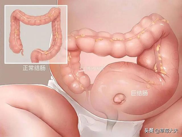 出生无肛门，肚子气球大！“气球宝宝”在草莓医院挺过来了